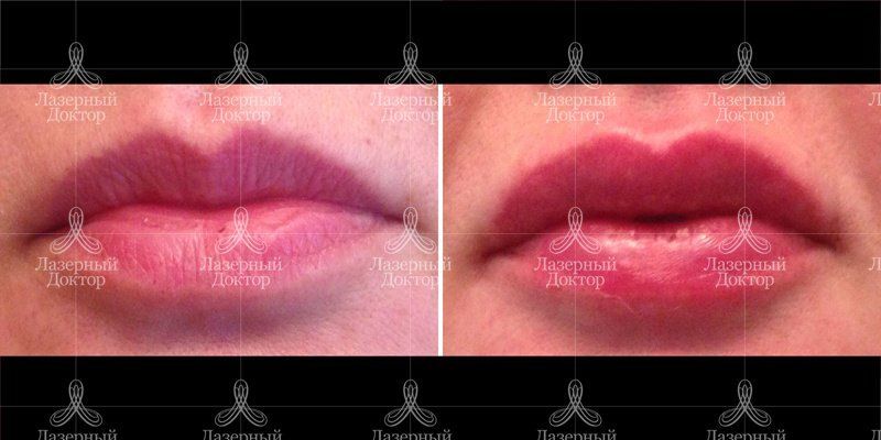 Увеличение губ с помощью гиалуроновой кислоты
