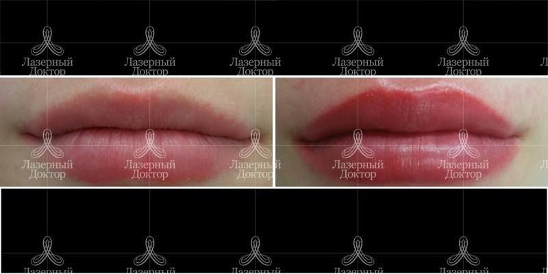 Увеличение губ: фото до и после